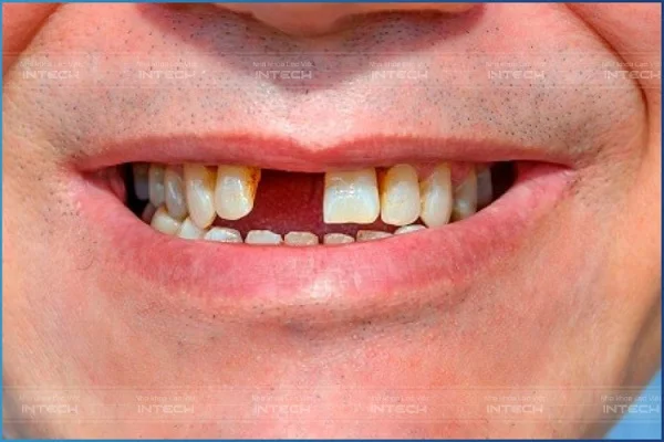 Gãy răng thương tích bao nhiêu phần trăm?
