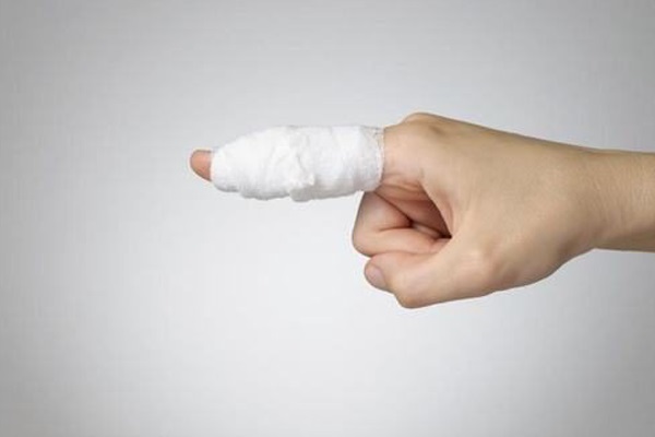 Cụt/gãy ngón tay tỷ lệ thương tật bao nhiêu phần trăm?